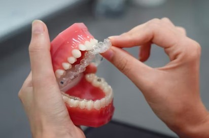 Sistema Invisalign digital