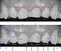 Diseño digital de sonrisa